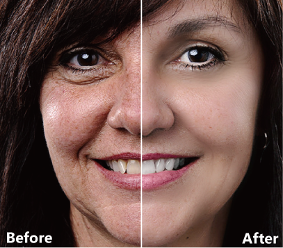 Before and after sample of smooth skin and blemish removal